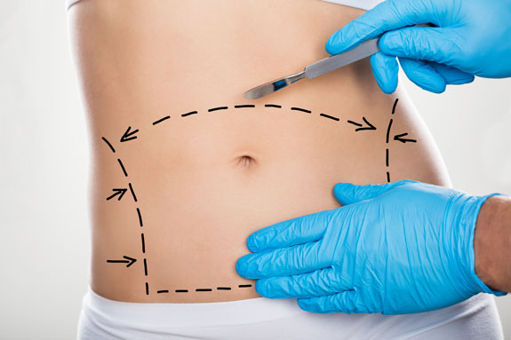 Abdominoplastik Hagen